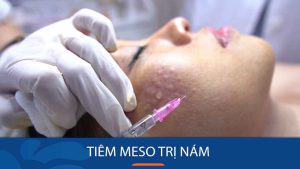 Tiêm meso trị nám: Giải pháp cho làn da trắng sáng mịn màng