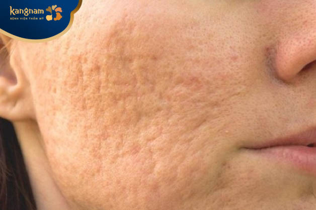 Liệu trình trị sẹo rỗ bằng phương pháp tiêm meso từ 3 - 6 lần/liệu trình