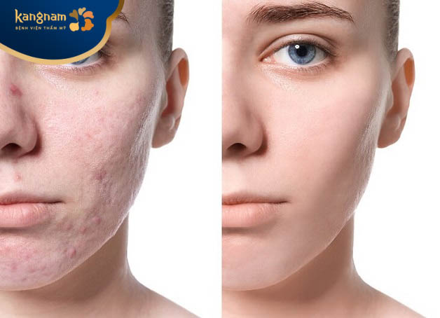 Tiêm meso điều trị sẹo rỗ có tốt không?