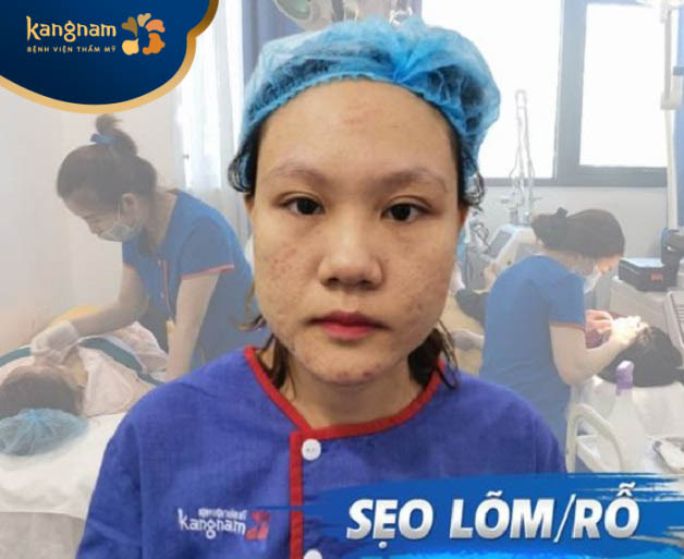 Trị sẹo lõm/rỗ tại Kangnam