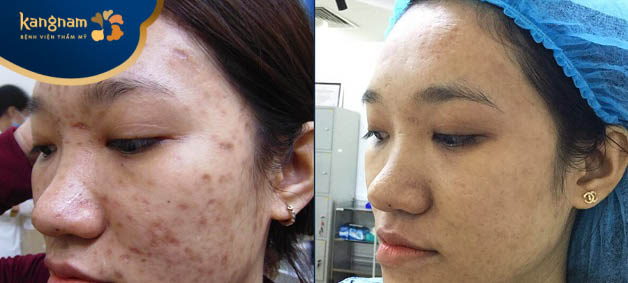 Bạn Thu Liên Feedback dịch vụ trị sẹo tạo Kangnam Hải Phòng