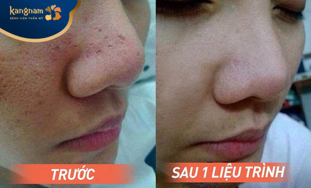 Bạn Quỳnh Mai (21 tuổi) feedback dịch vụ trị sẹo