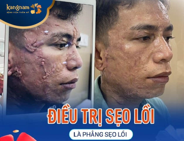 Anh Tuân trị sẹo tại Kangnam