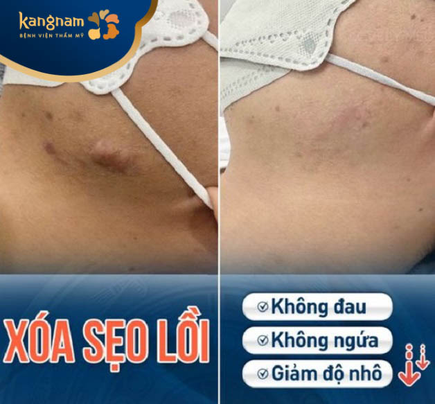 Trị sẹo lồi ở Kangnam Hải Phòng