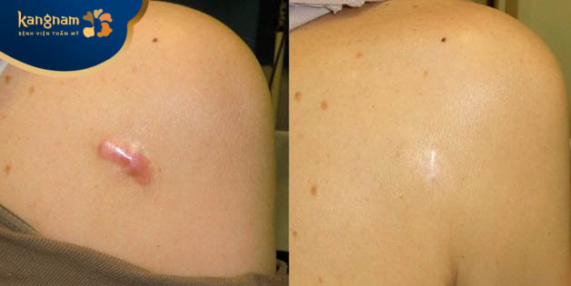 Bạn Trâm Anh gửi tin nhắn cho điều dưỡng của Kangnam để feedback về dịch vụ trị sẹo lồi.