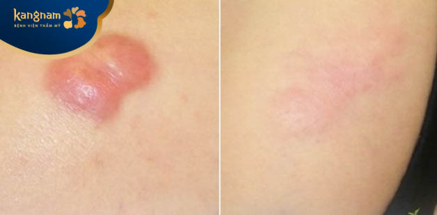 Bạn Mai Linh cũng vui mừng chia sẻ hình ảnh của mình sau 4 tháng trị sẹo lồi tại Viện thẩm mỹ Kangnam Nghệ An