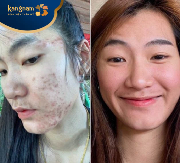 Bạn Thu Thảo trước và sau khi trị sẹo tại Kangnam