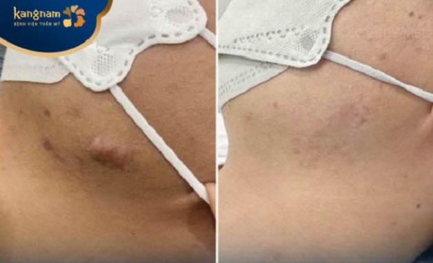 Xóa sạch sẹo lồi khi trị sẹo công nghệ cao