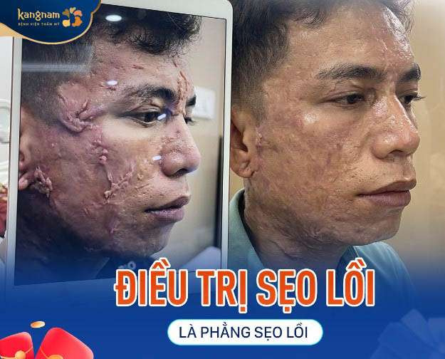 Là phẳng sẹo lồi nhanh chóng, hiệu quả cao