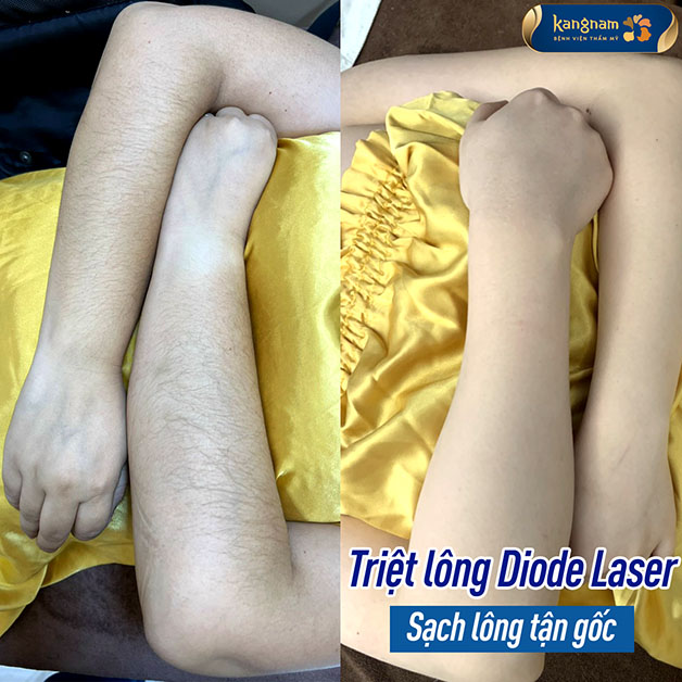 Hình ảnh khách hàng sau 4 buổi triệt lông tại Kangnam Nghệ An