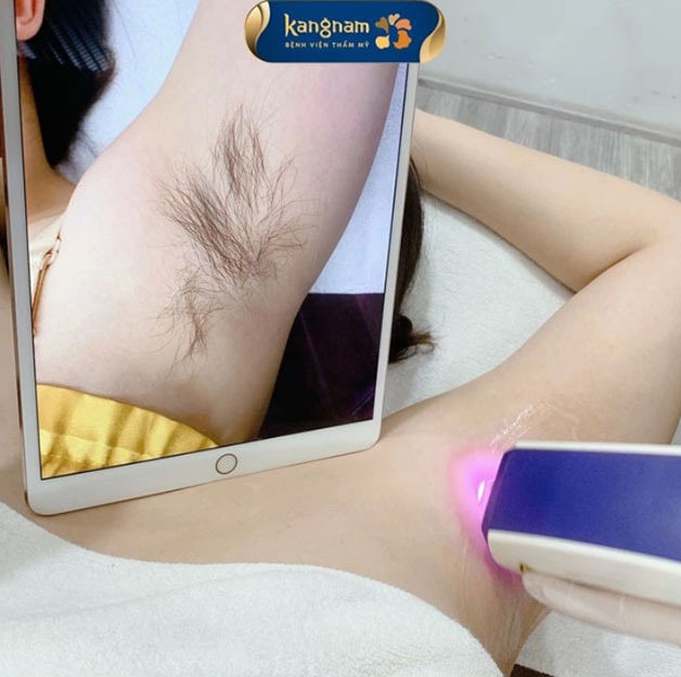Công nghệ Diode Laser không đau, không nóng rát