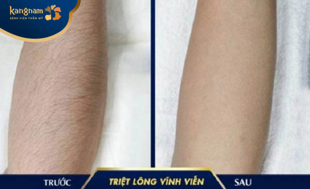 Bạn Khánh Vân triệt lông tay tại Kangnam Bắc Ninh