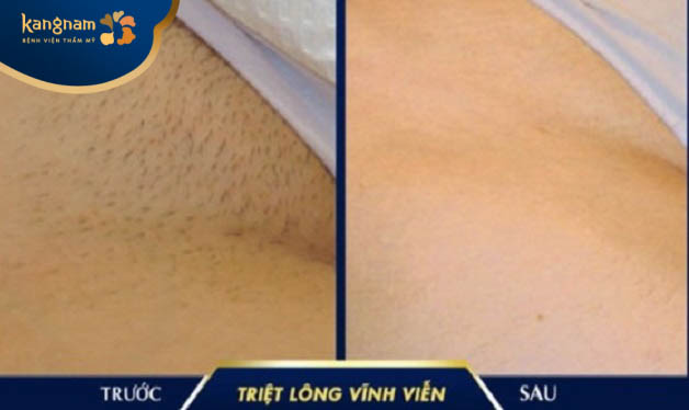 Ngọc Linh chia sẻ sau triệt lông vùng kín tại Kangnam