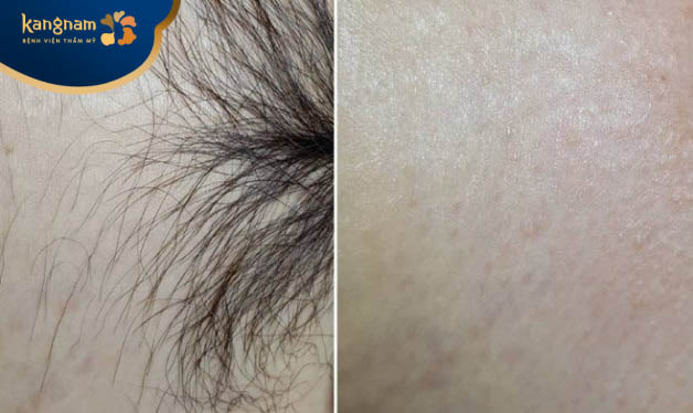 Khách hàngTú Anh không ngần ngại chia sẻ về trải nghiệm triệt lông bikini tại Kangnam