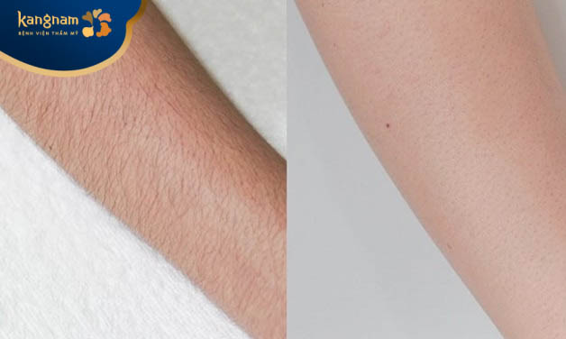 Chị Thùy Trang triệt lông tay tại Kangnam