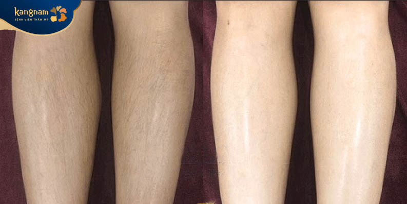 Bạn Vy Anh chia sẻ kết quả sau khi triệt lông tại Kangnam