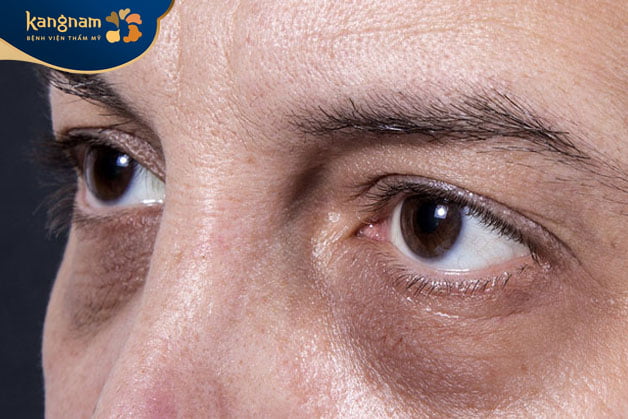 Tuổi tác cũng là nguyên nhân khiến mắt thâm quầng