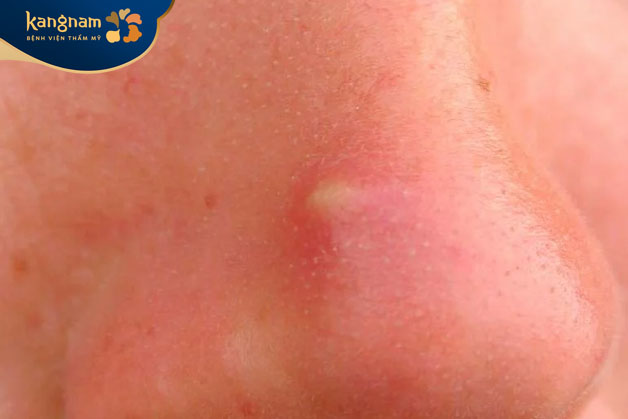 Mụn mủ do tắc nghẽn lỗ chân lông