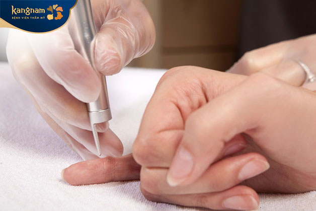 Tùy vào phương pháp điều trị mà thời gian điều trị sẽ kéo dài từ 2 - 12 tuần