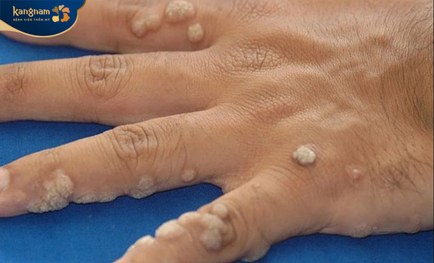 Mụn lây lan quá nhiều làm ảnh hưởng đến thẩm mỹ và cuộc sống