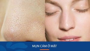 Mụn cám – Nỗi ám ảnh của mọi làn da: Bí quyết loại bỏ hoàn toàn chỉ sau 7 ngày