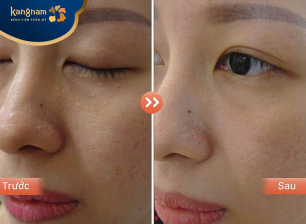 Mụn thịt ở mắt được loại bỏ hoàn toàn