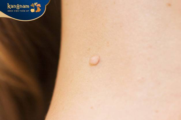 Mụn thịt dư có thể tái phát sau khi đã loại bỏ