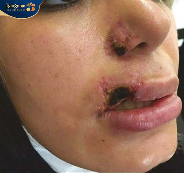 Với vùng môi bị hoại tử cần tìm đến bệnh viện để loại bỏ 