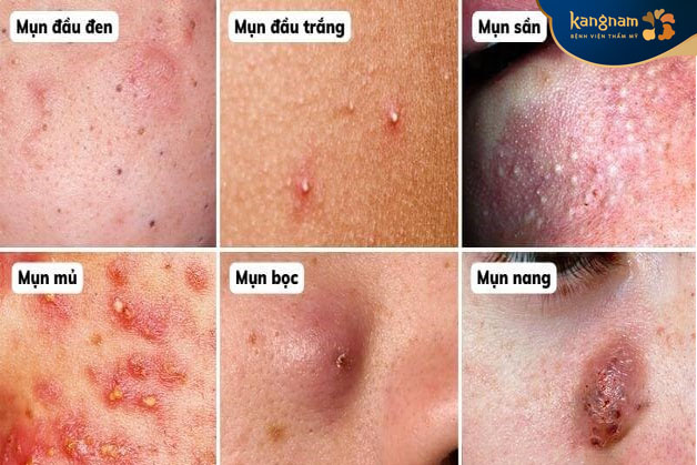 Các loại mụn gây mùi hôi thường gặp