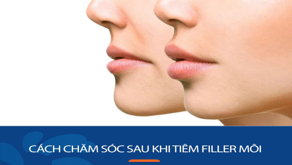 Cách chăm sóc sau khi tiêm filler môi để có kết quả đẹp nhất
