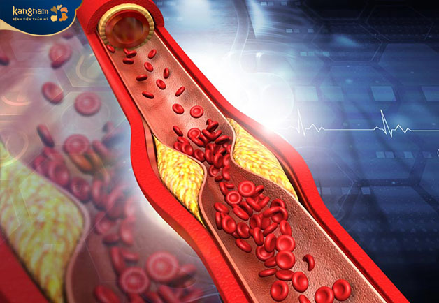 Mỡ máu là tình trạng thường ở ở độ tuổi trung niên