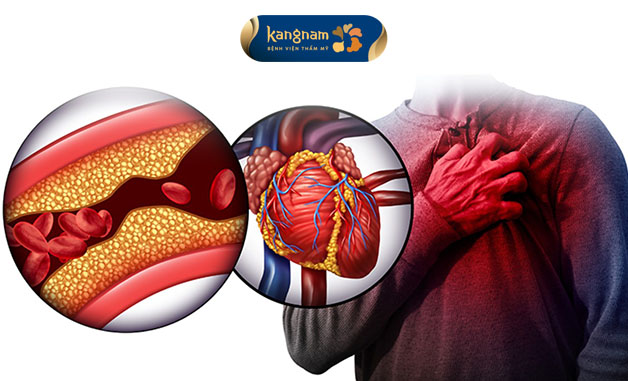 Hầu hết những ai bị mỡ máu đều có nguy cơ bị các bệnh liên quan tim mạch