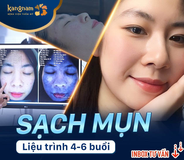 Ứng dụng công nghệ cao trị mụn không để lại thâm sẹo