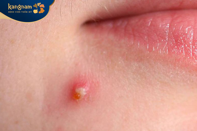 Mụn ẩn có màu đỏ hoặc hồng khi chúng mới hình thành