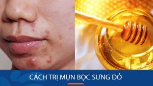 Bí quyết Đánh Bay Mụn Bọc Sưng Đỏ Vĩnh Viễn, Không Lo Sẹo Lõm!