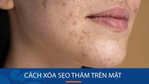 Cách xóa sẹo thâm trên mặt : Bí quyết xóa sẹo thâm trên mặt hiệu quả tại nhà