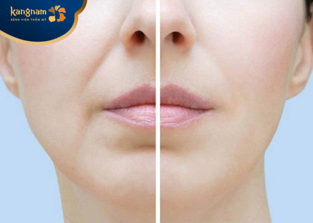 Căng chỉ xóa nhăn rãnh cười có đau không?