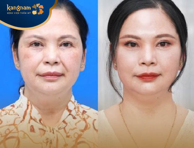 Căng chỉ để xóa nhăn rãnh cười có thể kéo dài lên đến 6 năm