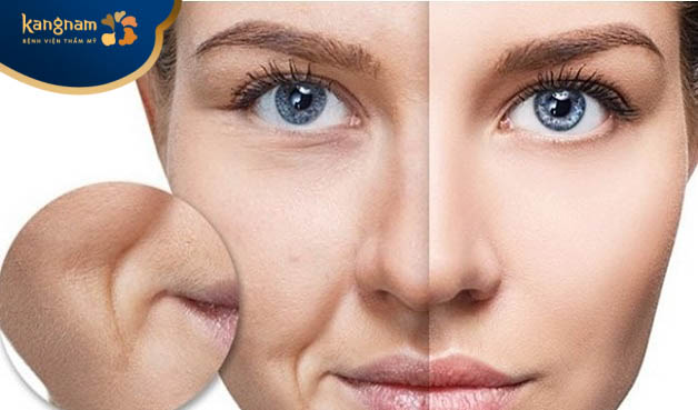 Căng chỉ rãnh cười là biện pháp xóa nhăn, trẻ hóa da