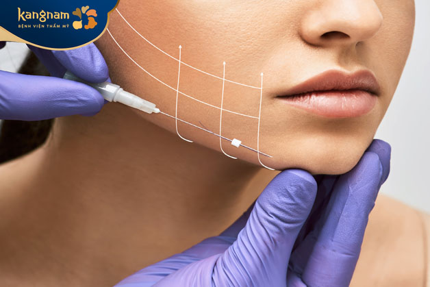 Phương pháp căng chỉ da tạo mặt V line không gây đau đớn