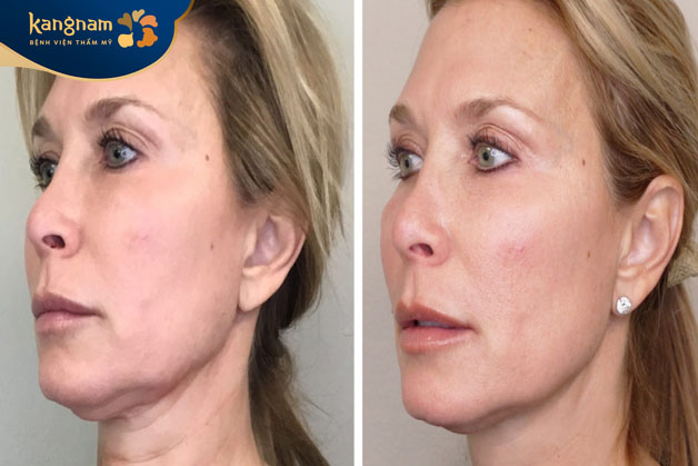 Giảm nhăn, chống chảy xệ cho da