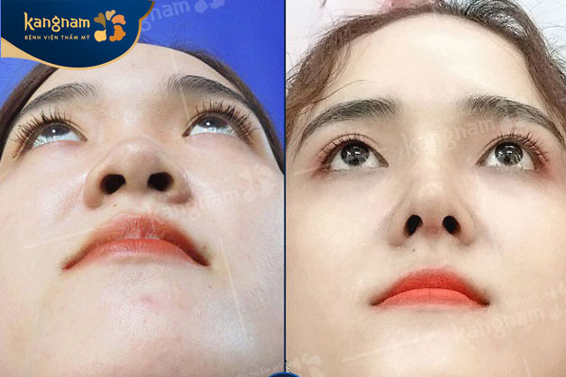 Thu gọn cánh mũi giúp gương mặt hài hòa, cân đối