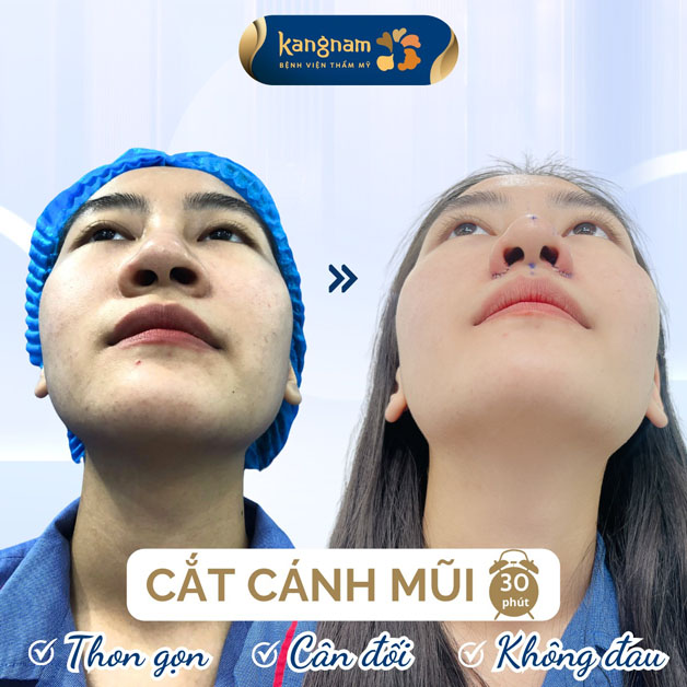 Cánh mũi thon gọn, thanh thoát, quá trình phẫu thuật không đau đớn
