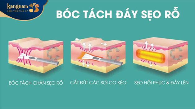Phương pháp này sẽ tác động trực tiếp vào chân sẹo nằm sâu trong bề mặt da 