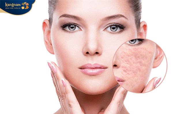 Bóc tách sẹo rỗ giúp cải thiện làm da bằng phẳng, mịn màng 