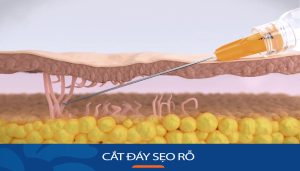 Cắt đáy sẹo rỗ: Giải pháp hoàn hảo cho làn da sẹo lõm