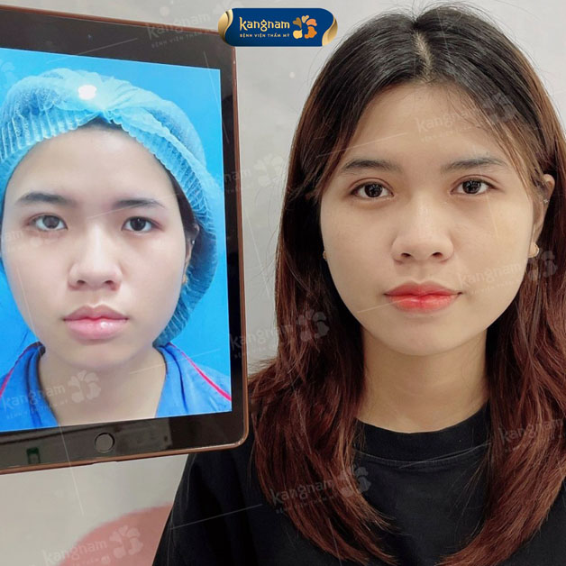 Nếp mí rõ ràng, tăng thần sắc cho gương mặt