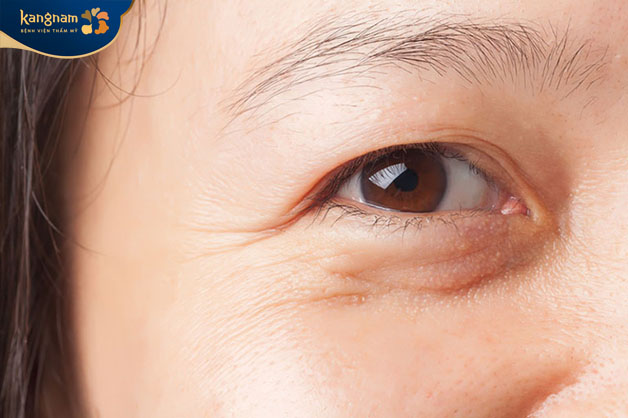 Tuổi tác cũng làm ảnh hưởng đến thời gian duy trì nếp mí 