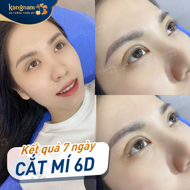 Khách hàng hài lòng, hạnh phúc khi có nếp mí mới đều và đẹp hơn