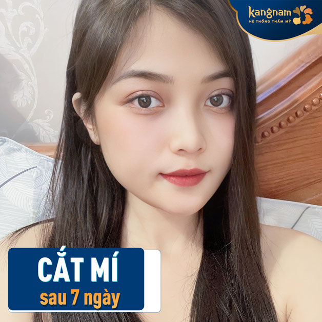 Mí mắt cân đối, gương mặt trở nên thanh thoát hơn